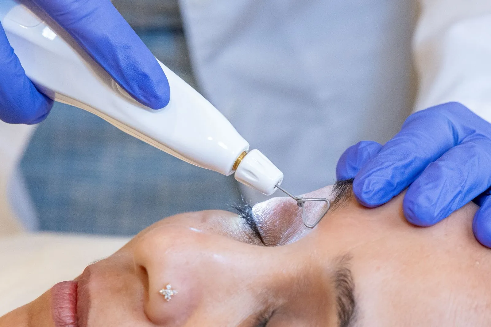 Plasma (Plexr) soft-surgery treatment at Arbour Longevity