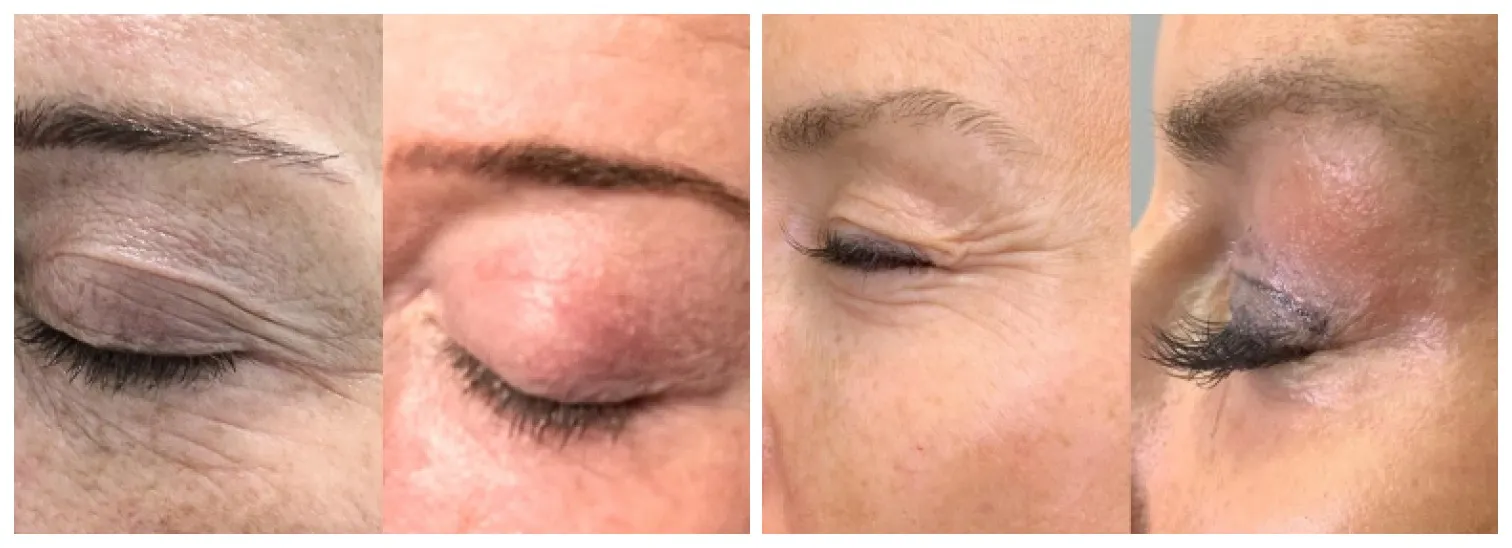 Before and after under-eye rejuvenation treatment results