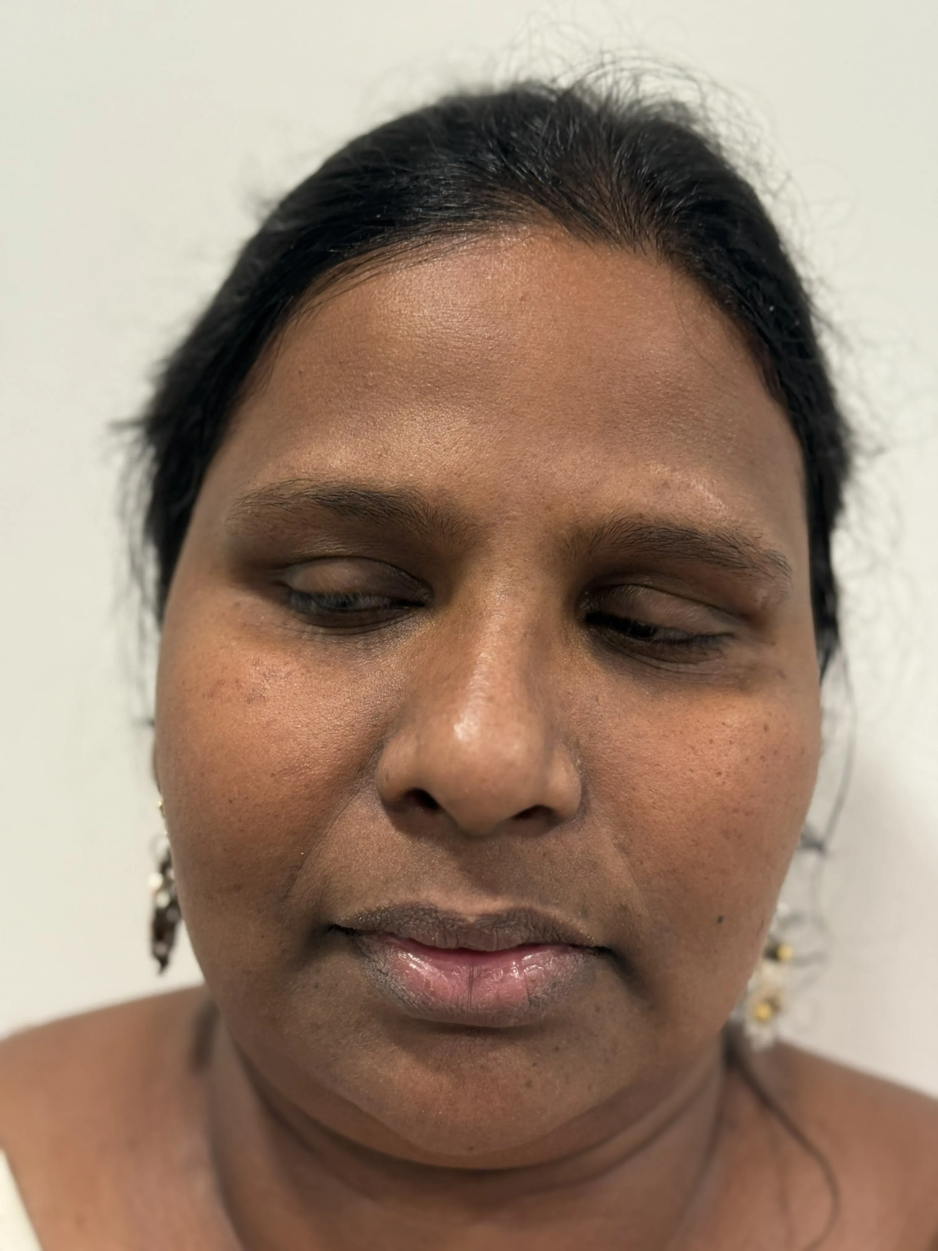 PRP treatment before photo at Arbour Longevity