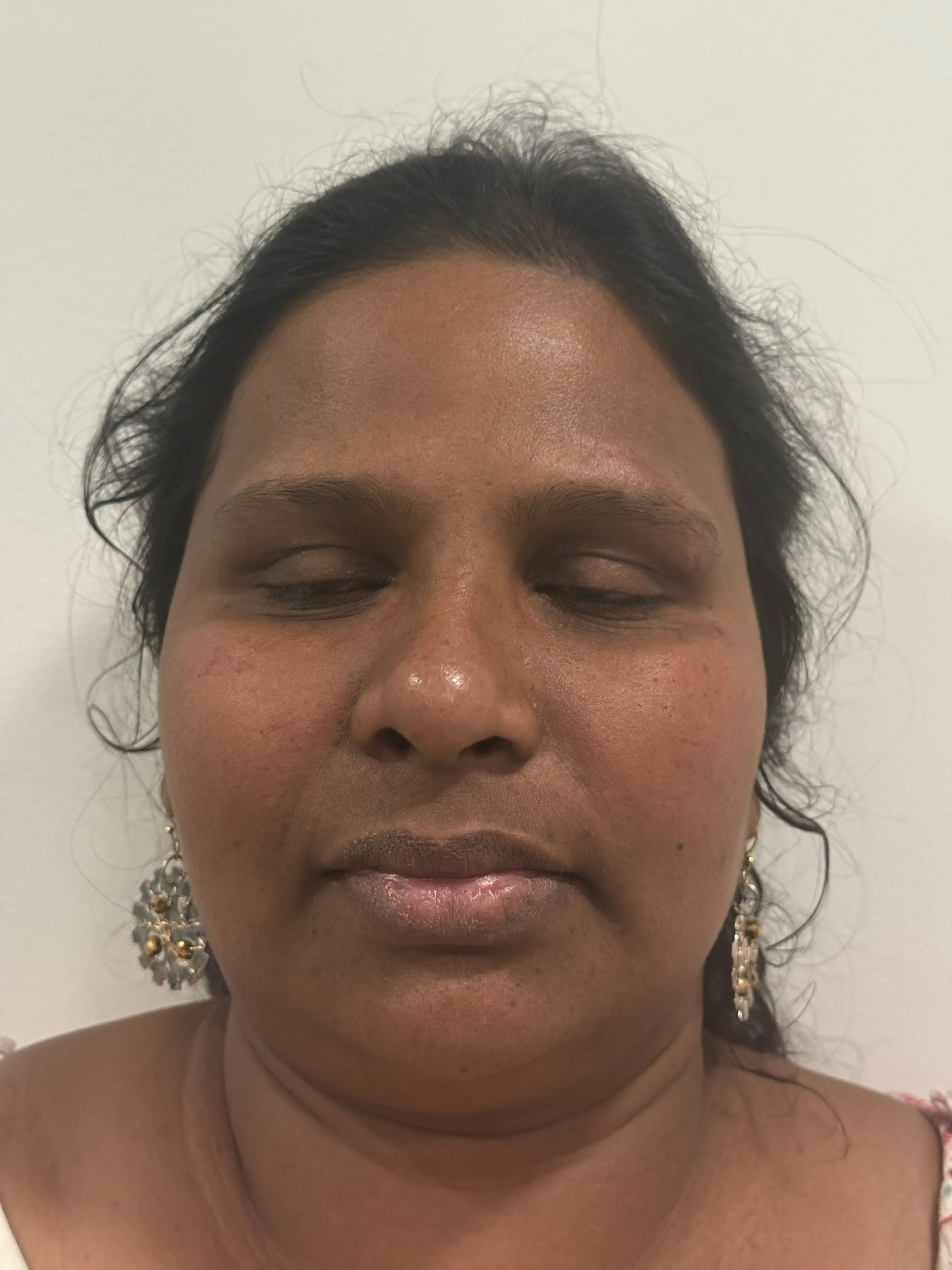 PRP treatment after results at Arbour Longevity