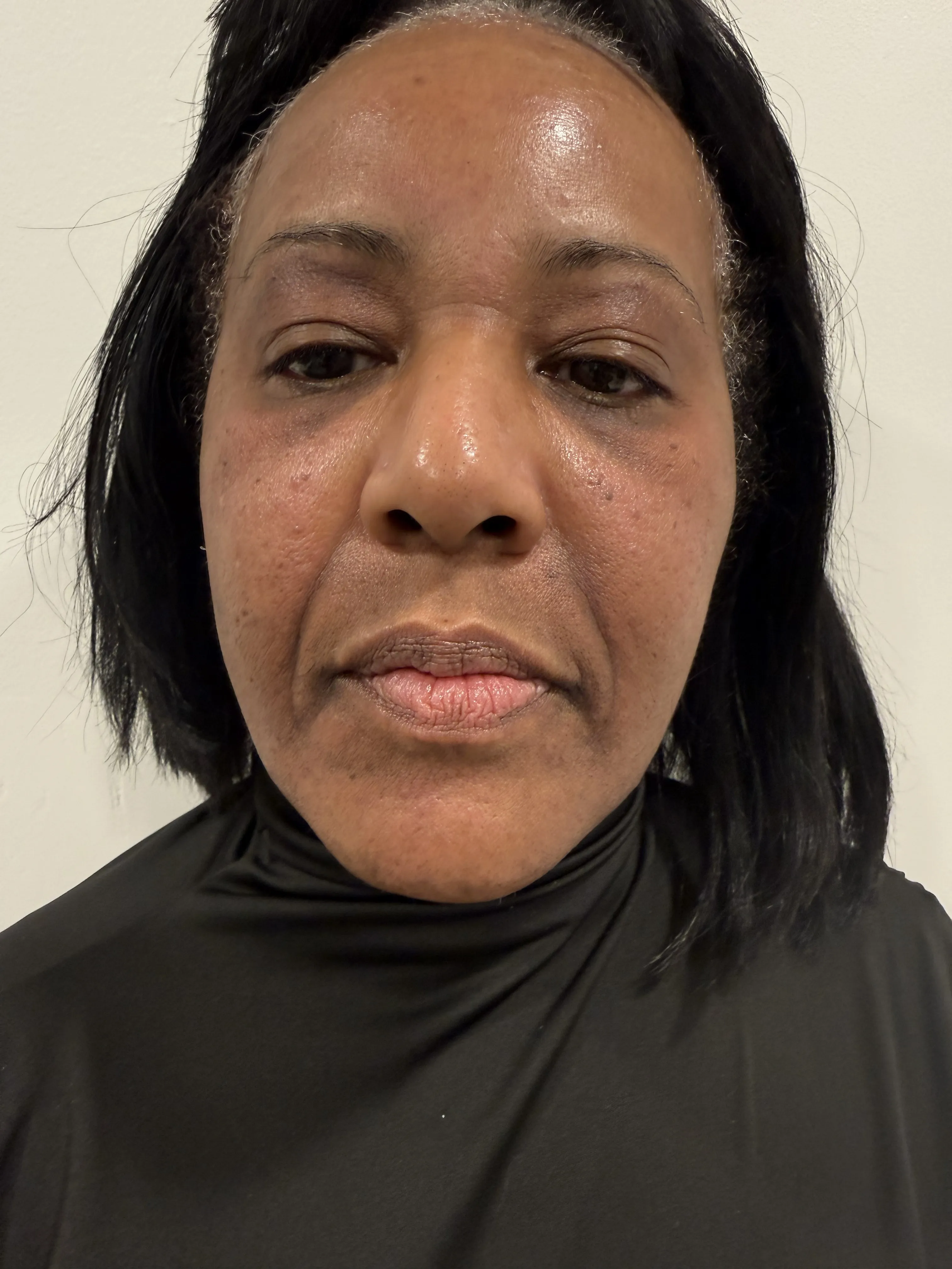 Botox treatment after results at Arbour Longevity
