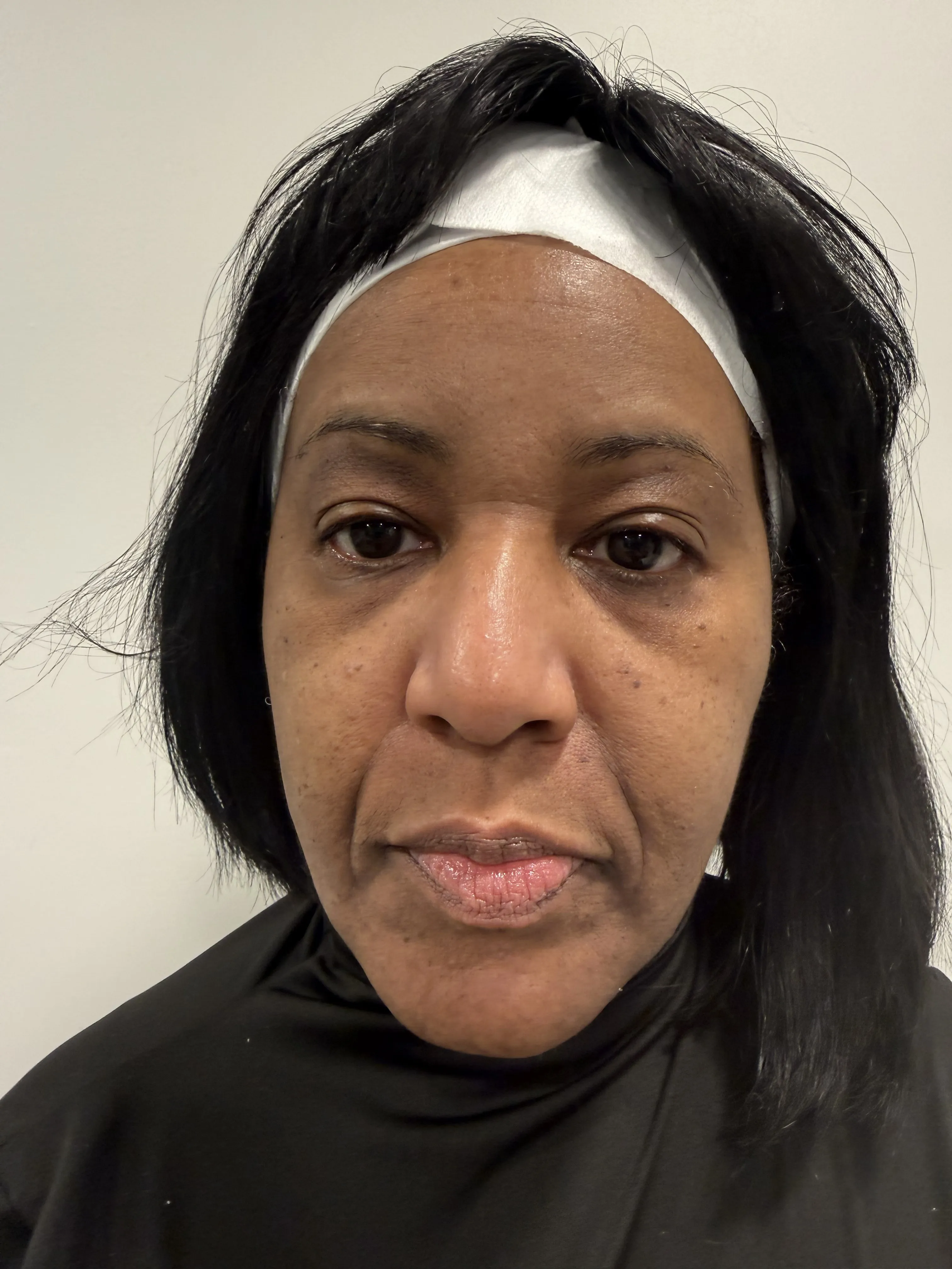 Botox treatment before photo at Arbour Longevity