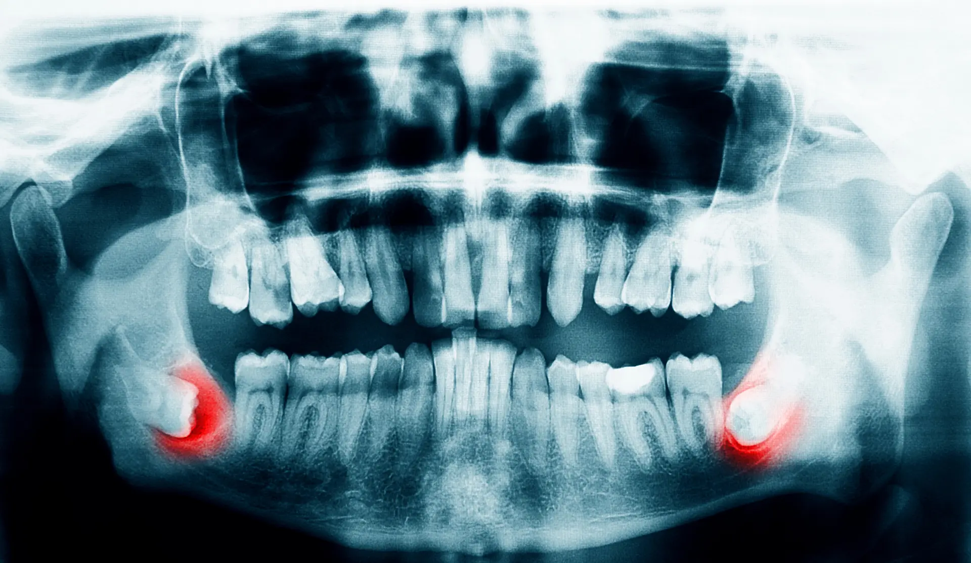 Wisdom Teeth Removal