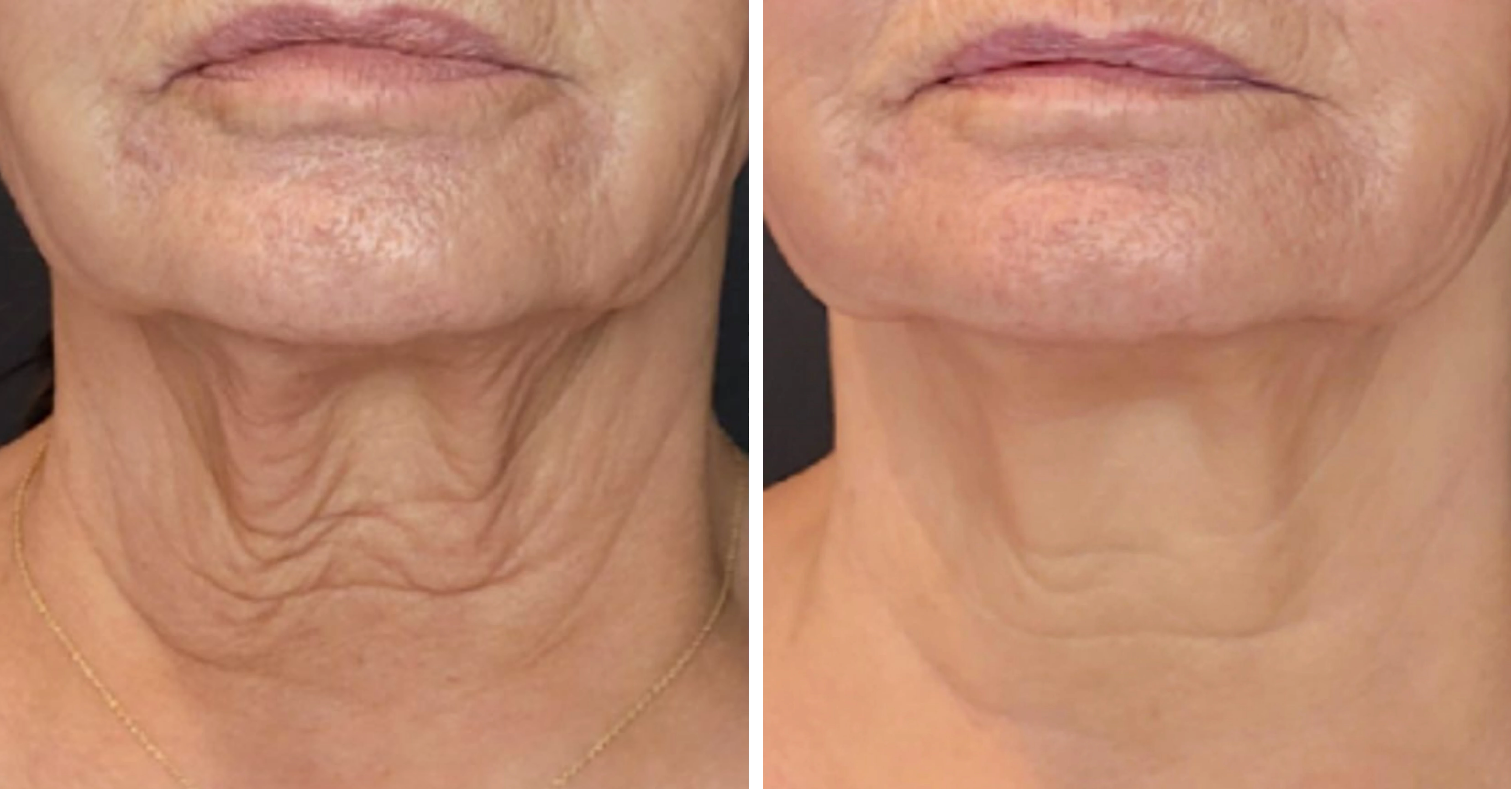 Side-by-side comparison of a neck before and after skin tightening treatment, showing reduced wrinkles and smoother skin on the right.