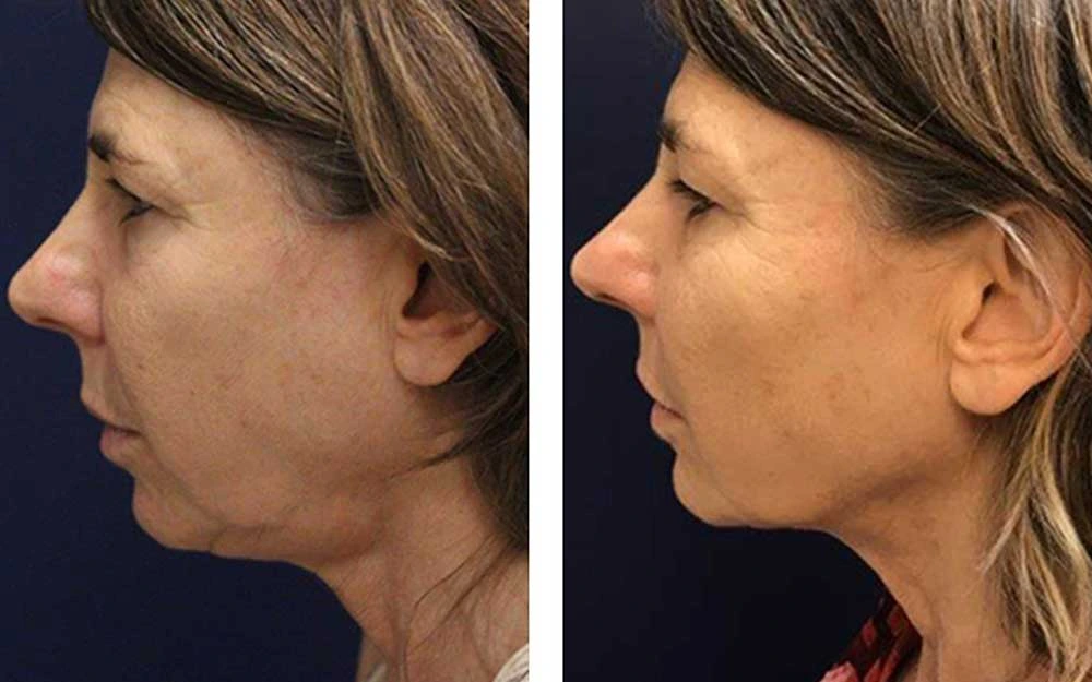 Side-by-side profile photos of a middle-aged woman showing before and after a cosmetic procedure that tightens and smooths the skin around her jawline and neck.