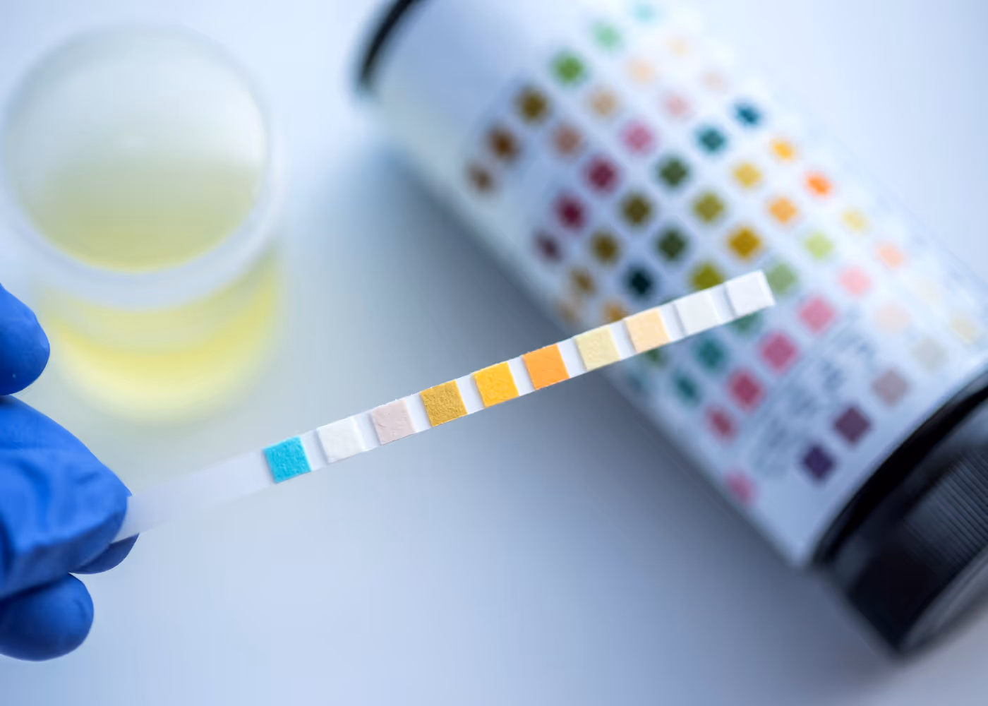 Gloved hand holding urine test strip with color chart bottle and urine cup in the background.