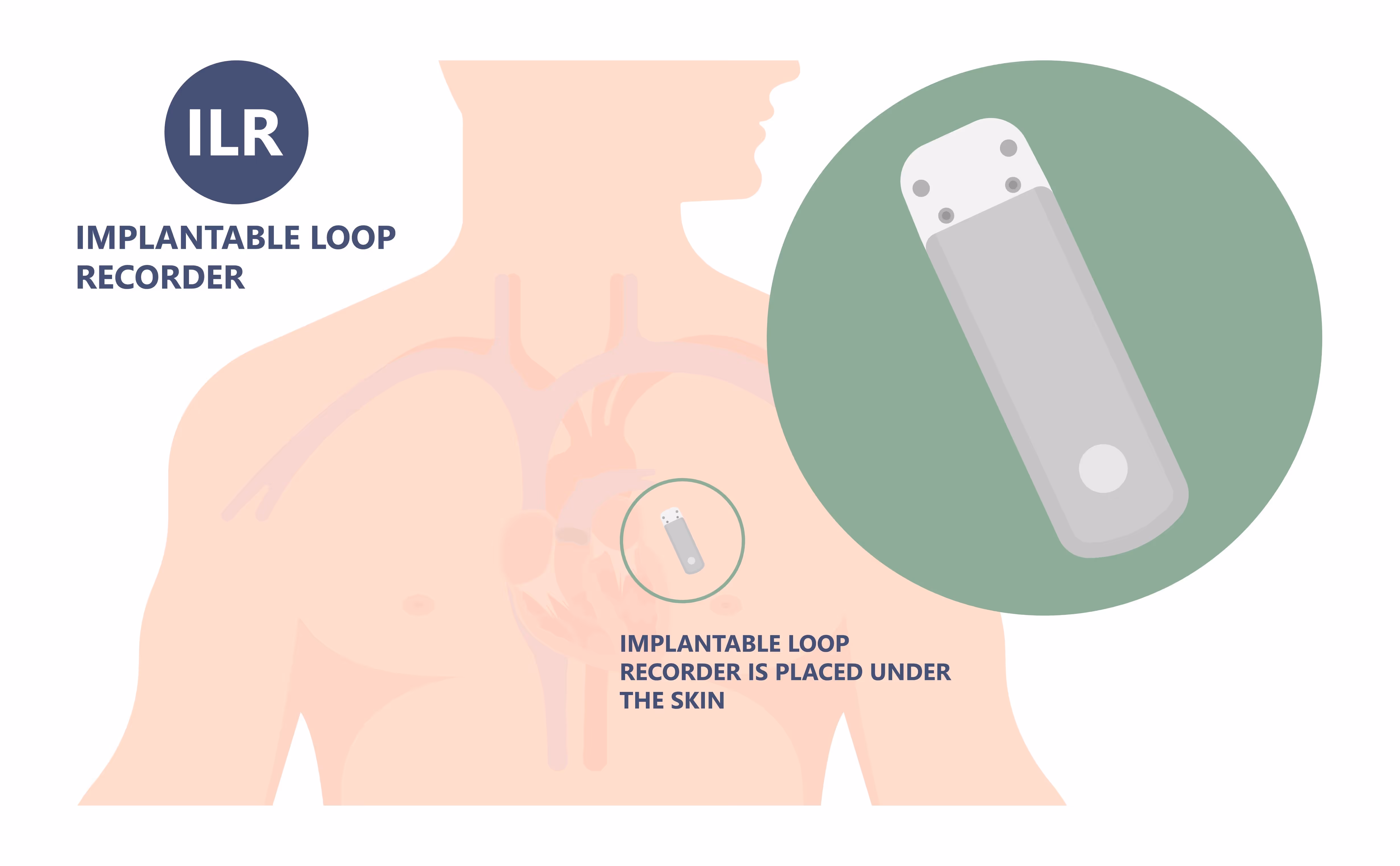 Diagram of an implantable loop recorder device placed under the skin near the heart area.