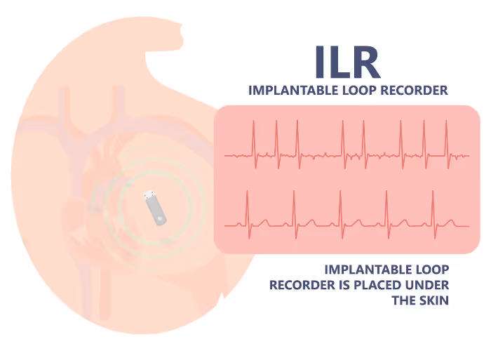 Implantable Loop Recorder device placed under skin with heart rate ECG waves shown.
