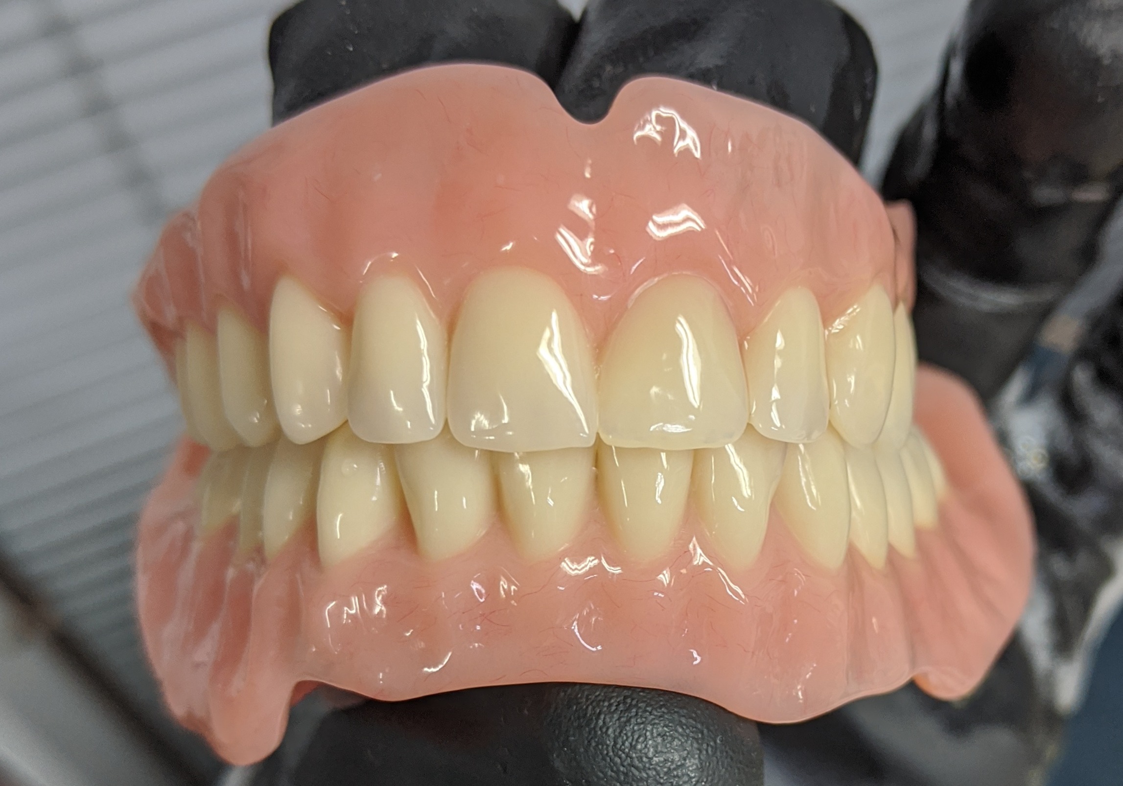 Handcrafted full upper denture case by Scott Payne at Creative Dentures Gordon Park
