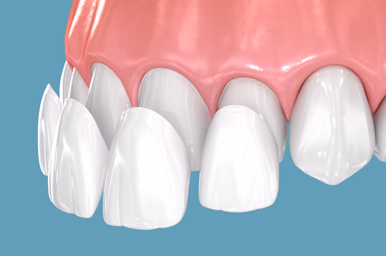 Porcelain Veneers in West Long Branch, NJ