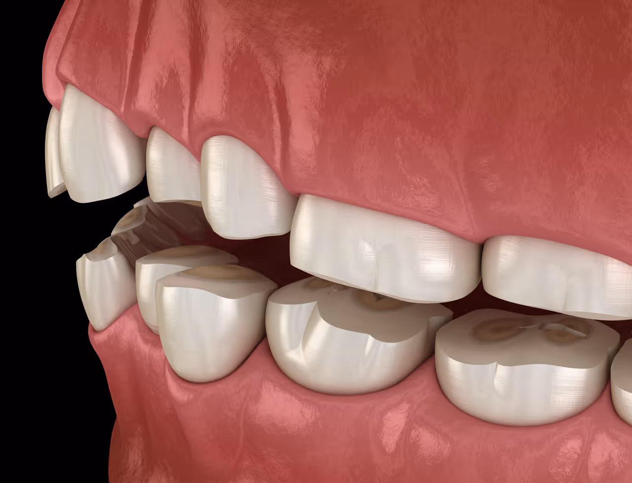 Bruxism Treatment in West Long Branch, NJ