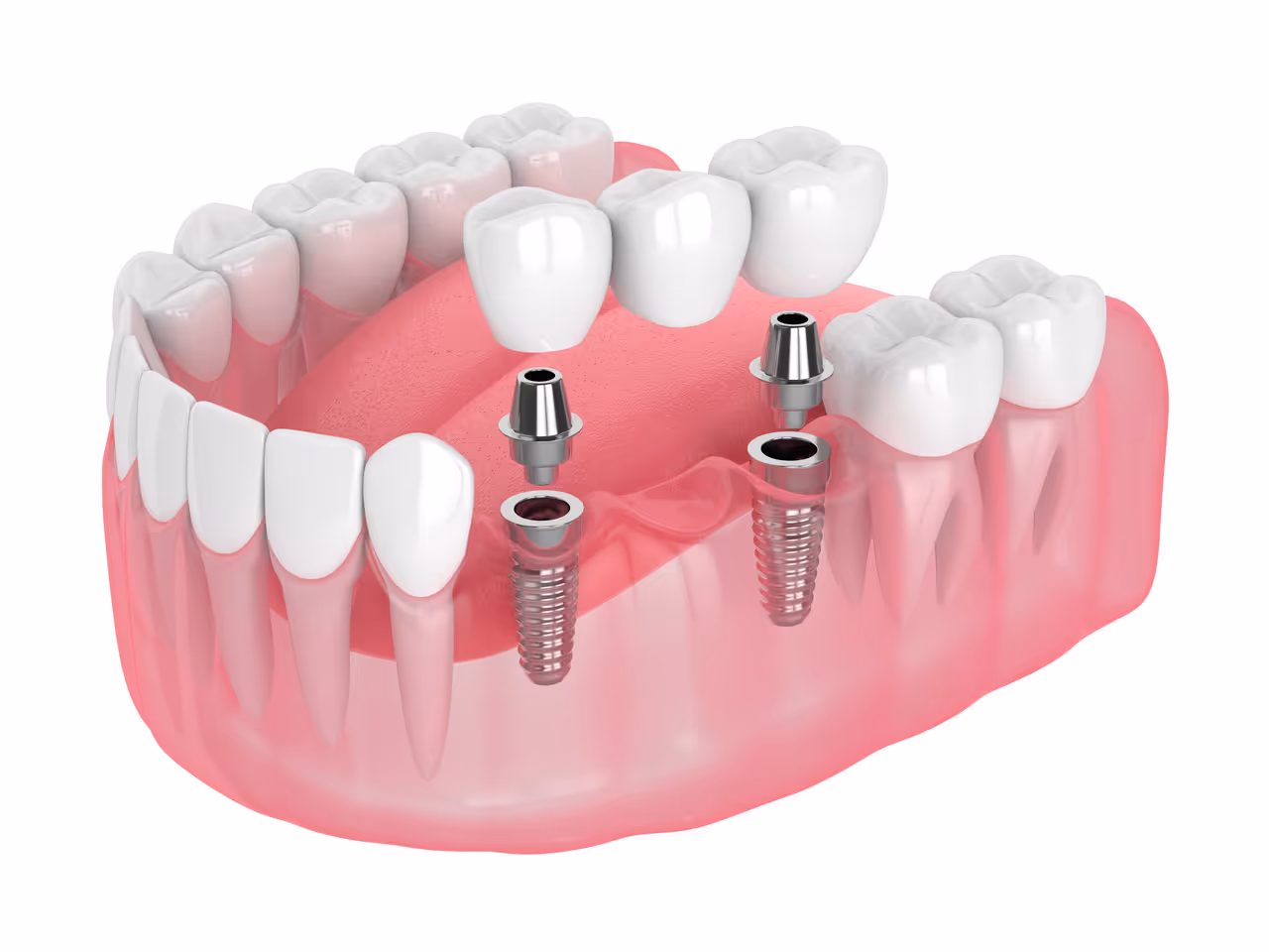 Dental Bridges in West Long Branch, NJ