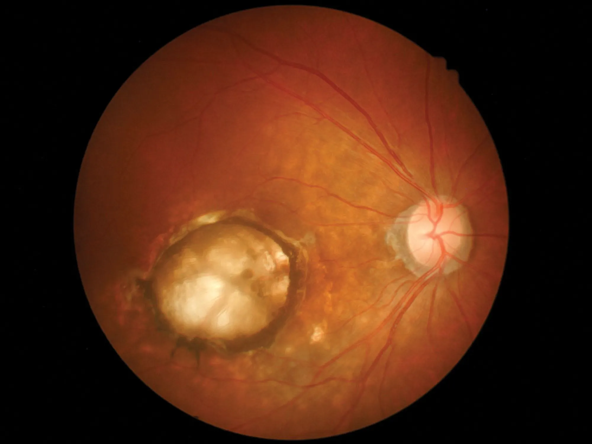 Retinal photograph showing the back of the eye, with the optic disc on the right and a large pale lesion affecting the macula.