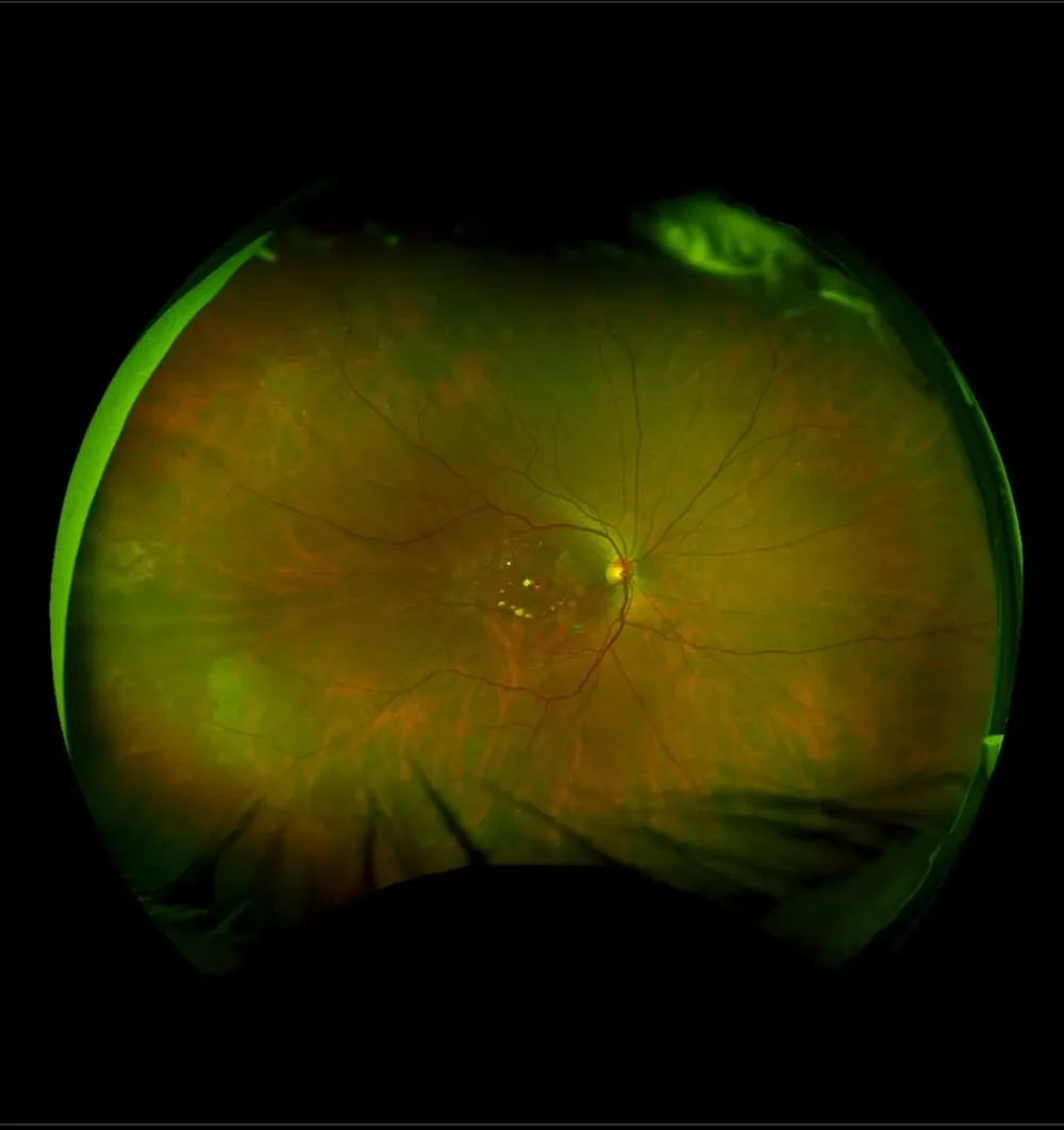 Wide-angle retina scan showing optic disc, blood vessels, and surrounding tissue in green and orange tones.
