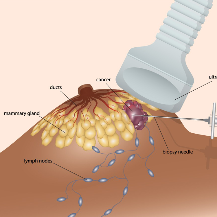 Cryoablation procedure showing image-guided freezing of breast tumor tissue