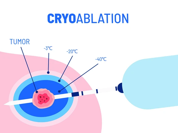 Image-guided cryoablation procedure for breast tumor treatment in Austin, TX