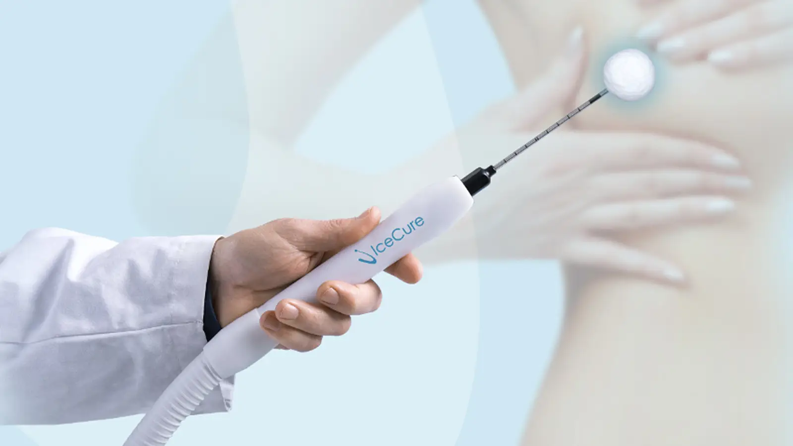 Image-guided cryoablation procedure for breast tumor treatment in Round Rock, TX