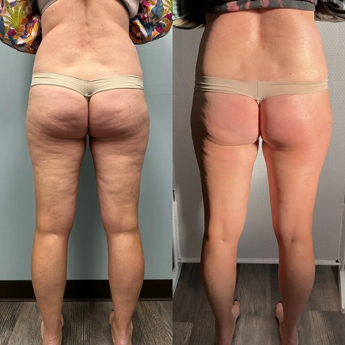 Back and legs before and after three Advanced Body Contouring treatments