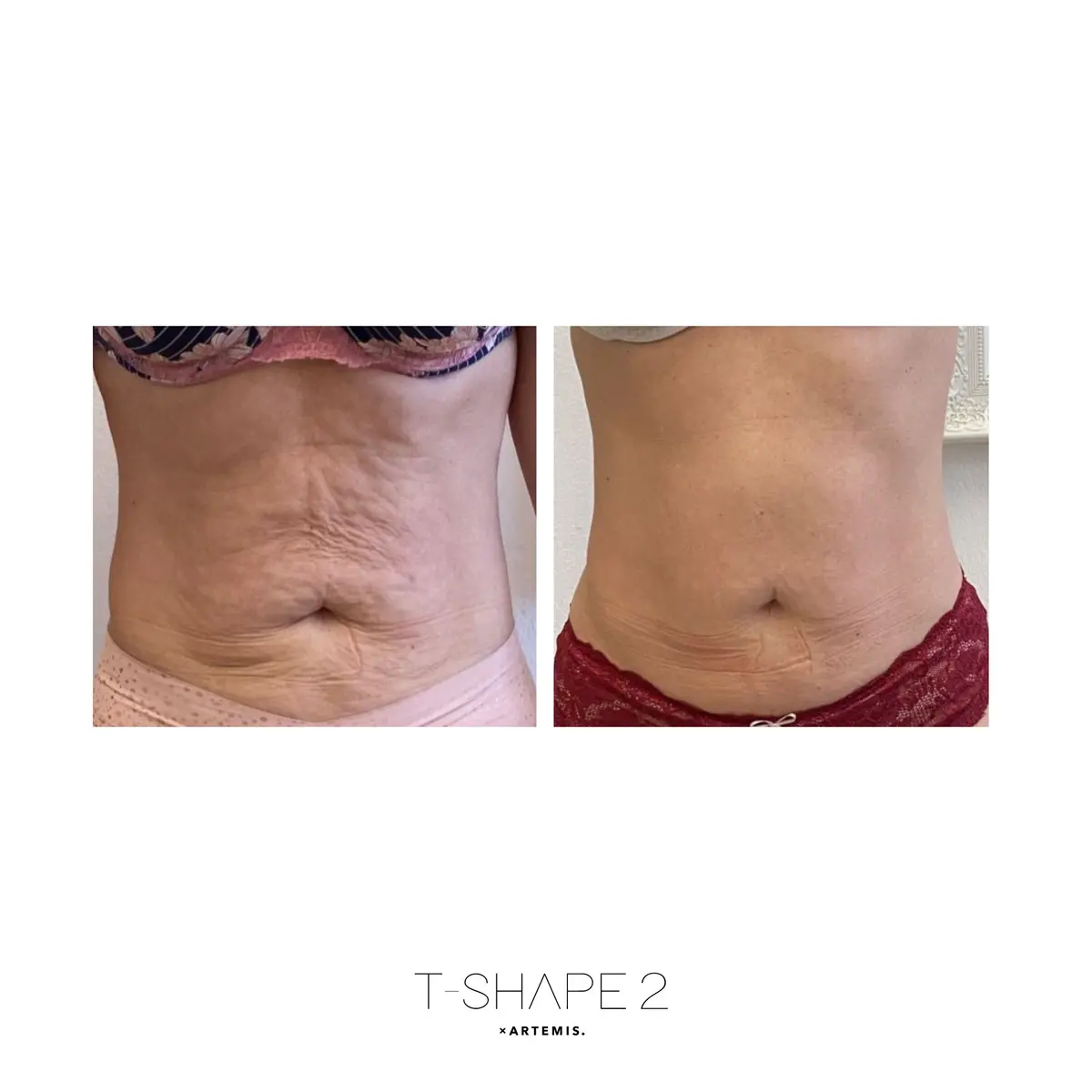 Abdomen before and after Advanced Body Contouring treatment