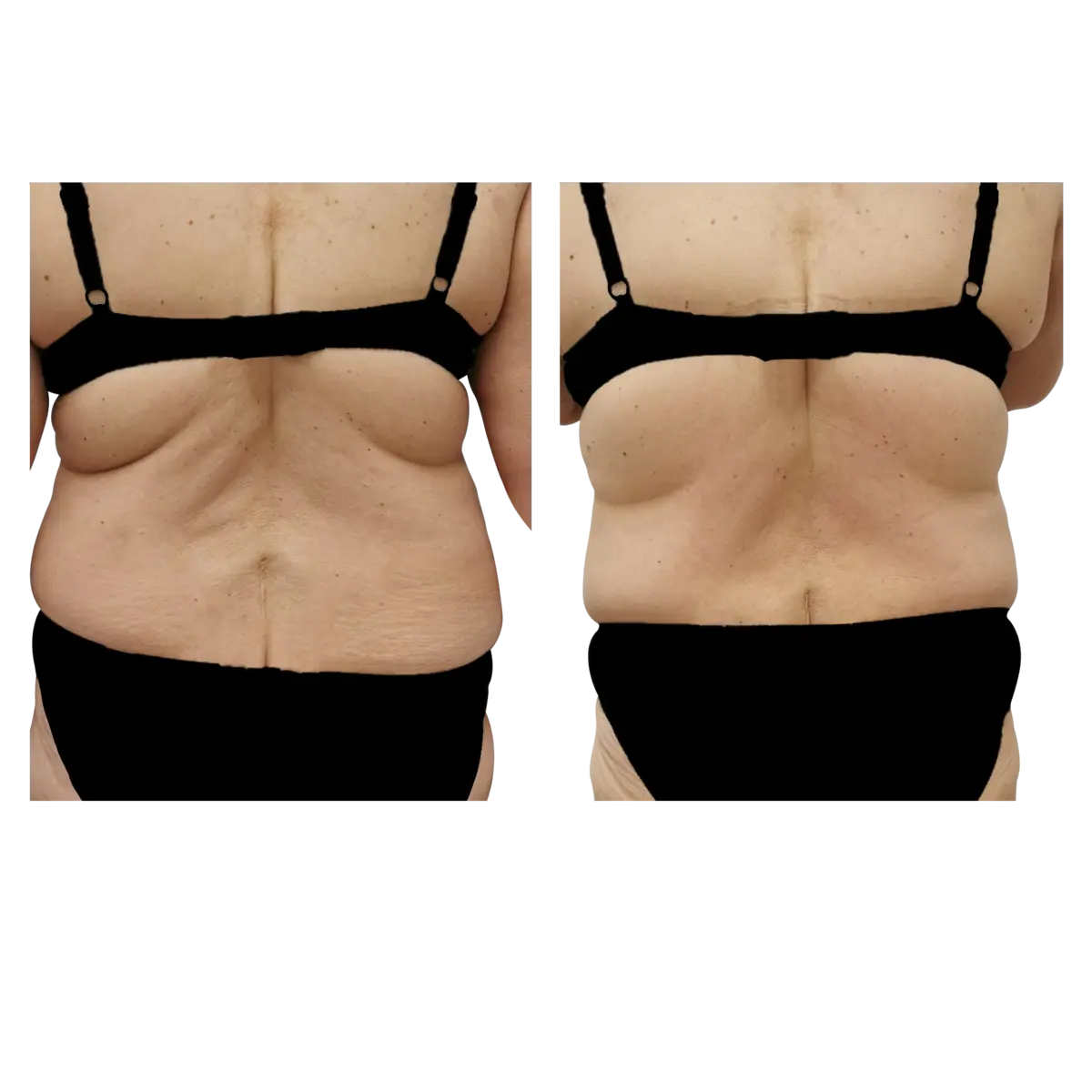 Back before and after ten Advanced Body Contouring treatments