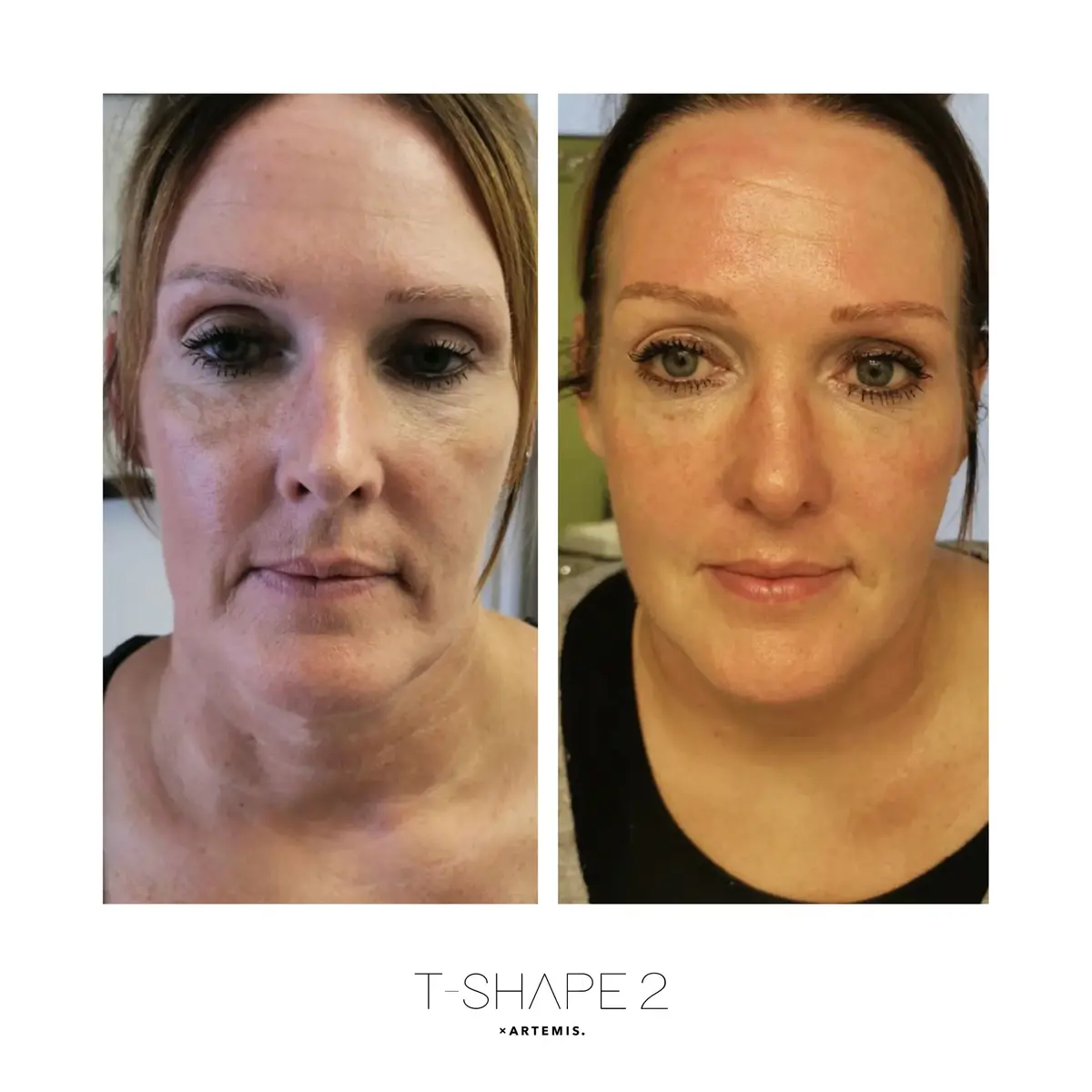 Face front angle before and after four Advanced Body Contouring treatments