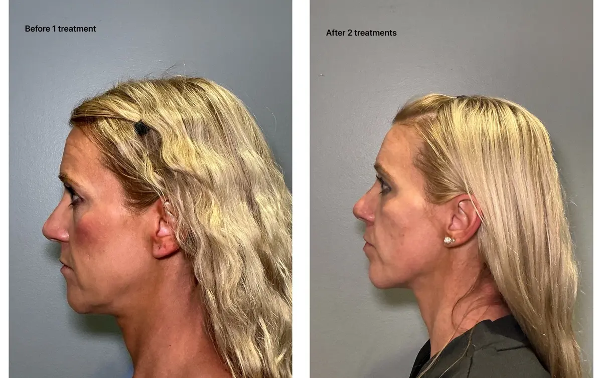 Face and jawline before and after two Advanced Body Contouring treatments