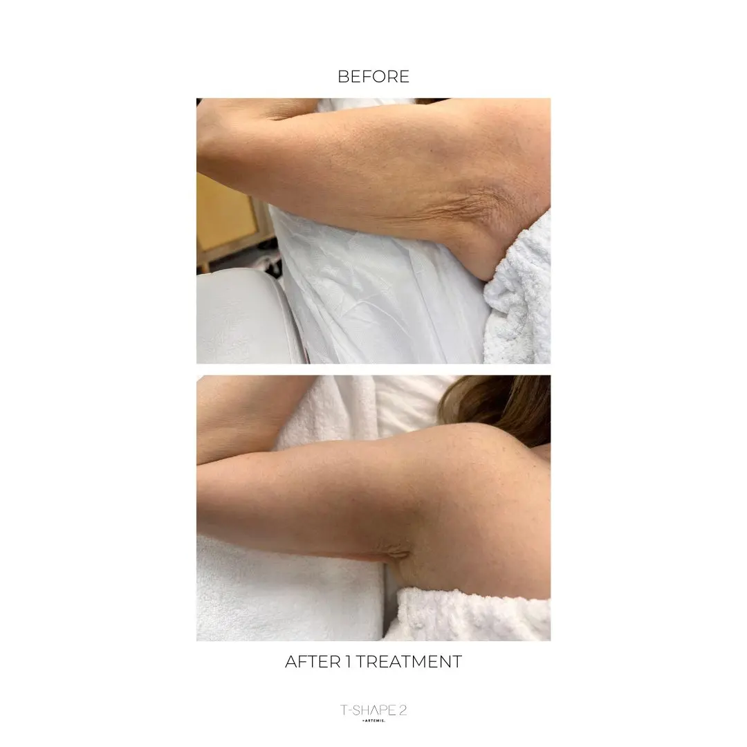 Upper arm before and after one Advanced Body Contouring treatment
