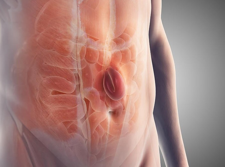 Medical illustration of a ventral hernia protruding through the abdominal wall