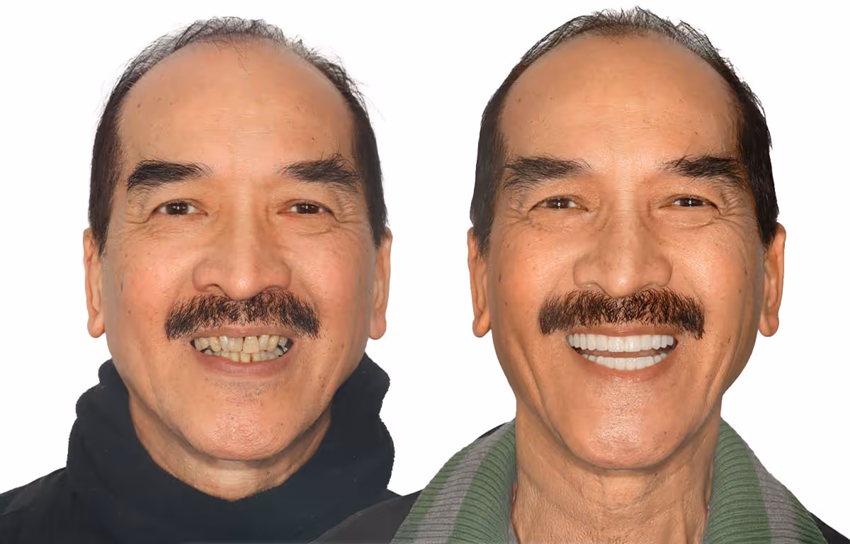 Before and after dental restoration improving smile symmetry and confidence by Dr. Anna Gazu