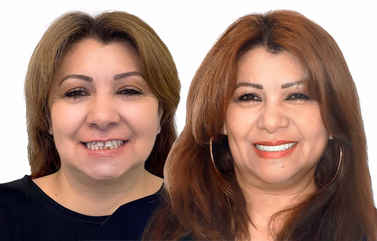 Before and after smile makeover with enhanced shape and color by Dr. Anna Gazu