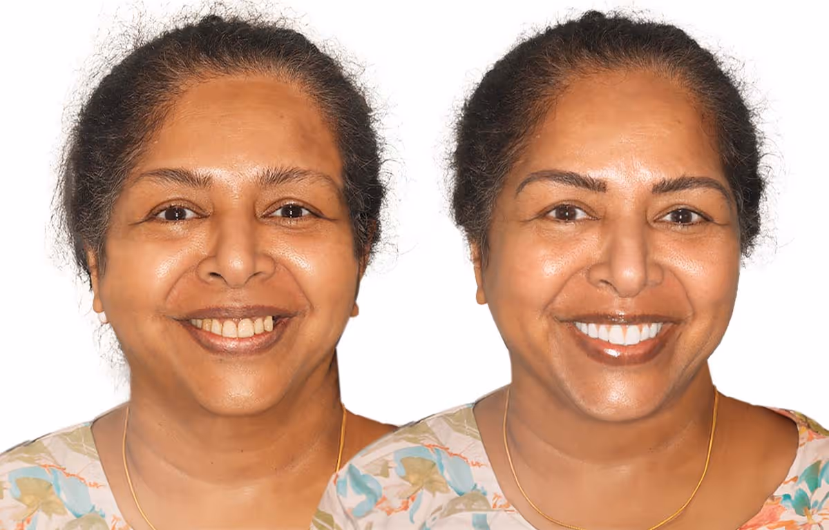 Before and after cosmetic dental treatment creating a brighter, balanced smile by Dr. Anna Gazu