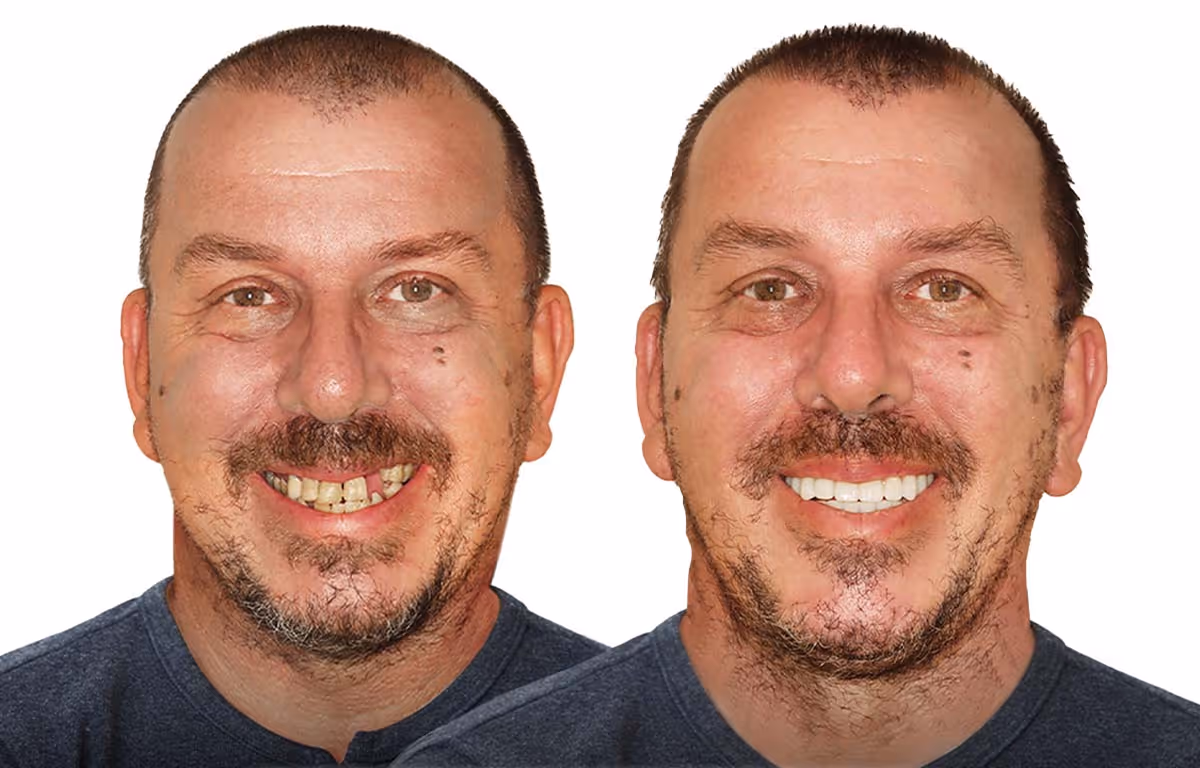 Before and after smile transformation showing improved alignment and whitening by Dr. Anna Gazu