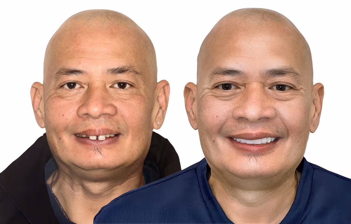 Before and after dental treatment showing healthier, fuller smile by Dr. Anna Gazu