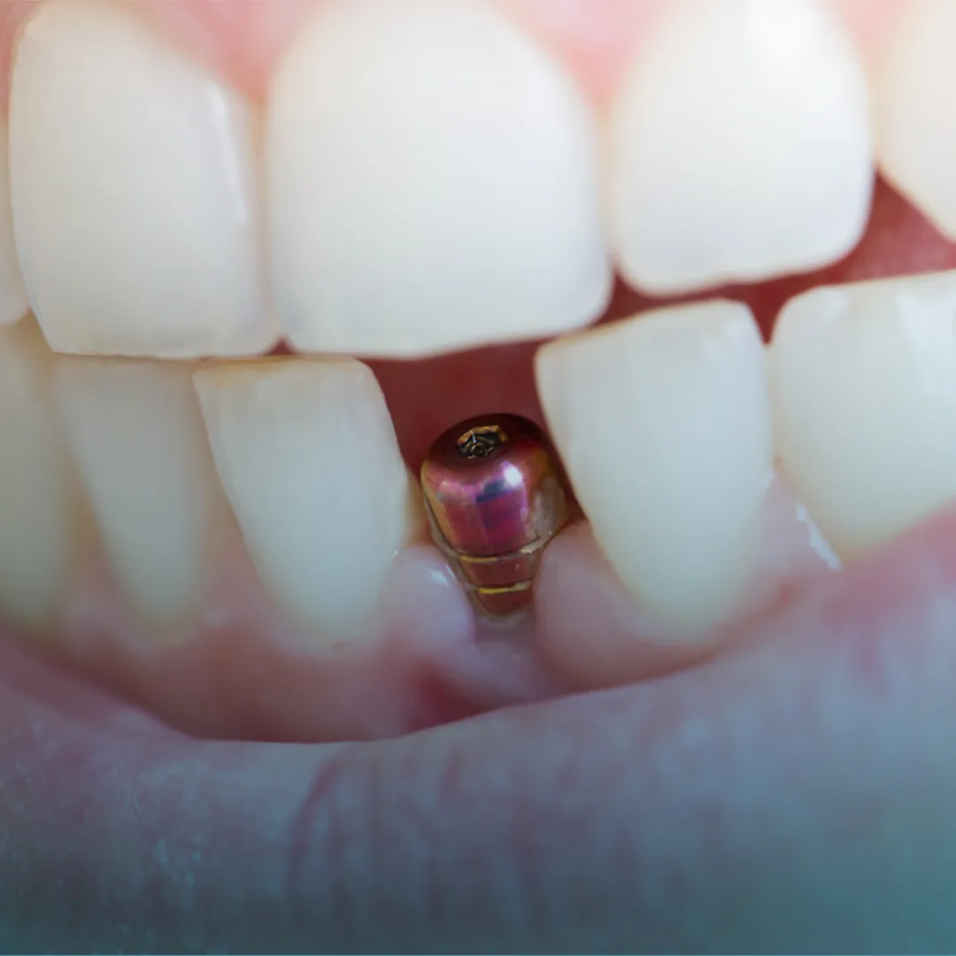 What is a single tooth dental implant at Marvel Dental in Clifton NJ