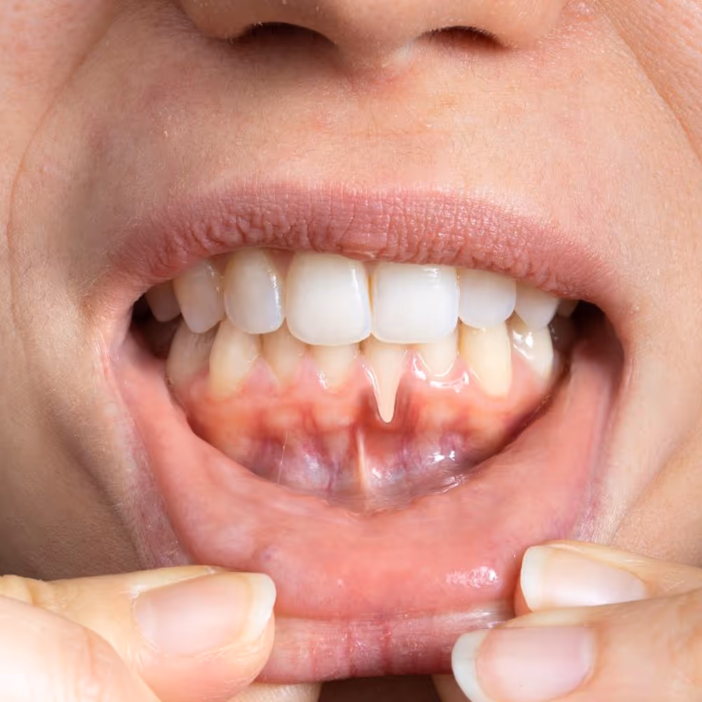 Illustration of gum disease progression and periodontal treatment to restore gum health