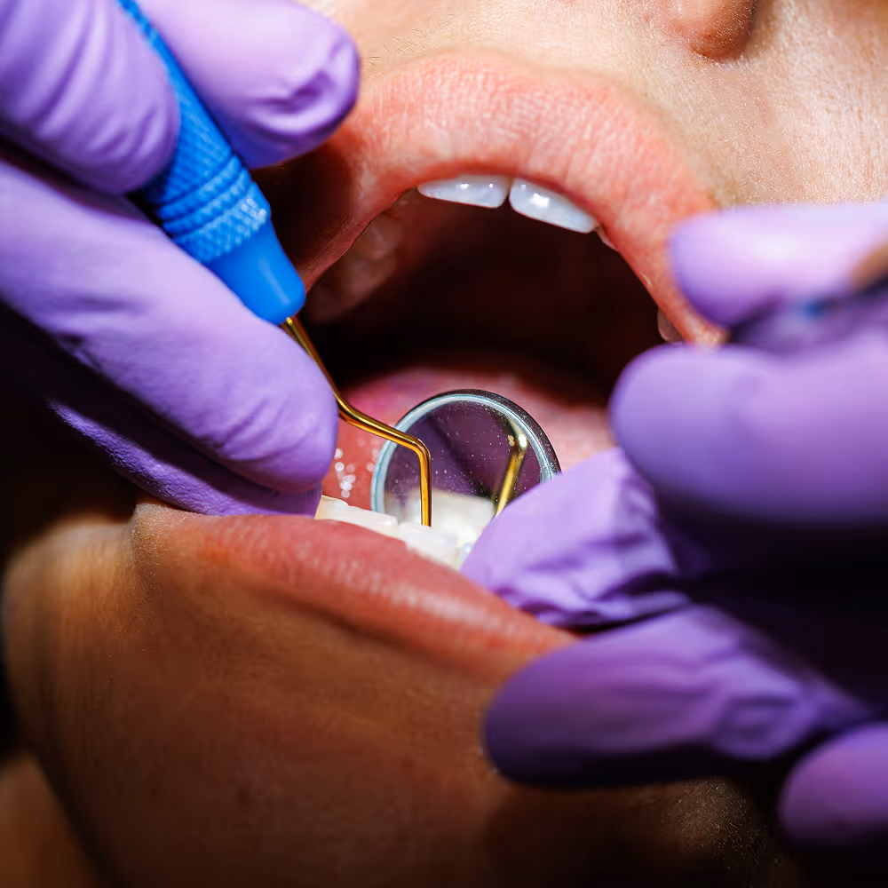 Dental deep cleaning showing scaling and root planing to treat gum disease and smooth tooth roots
