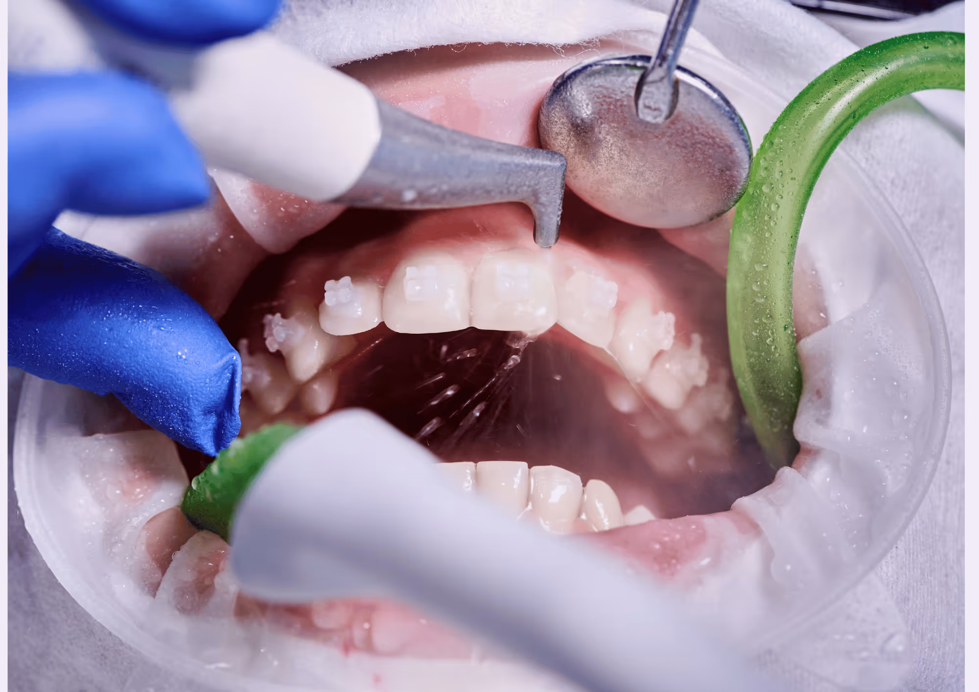 What is prophylactic dental cleaning and how it protects oral health