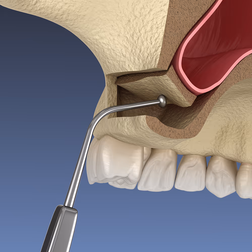 Dental sinus lift surgery illustration showing lifted sinus membrane and bone graft placement