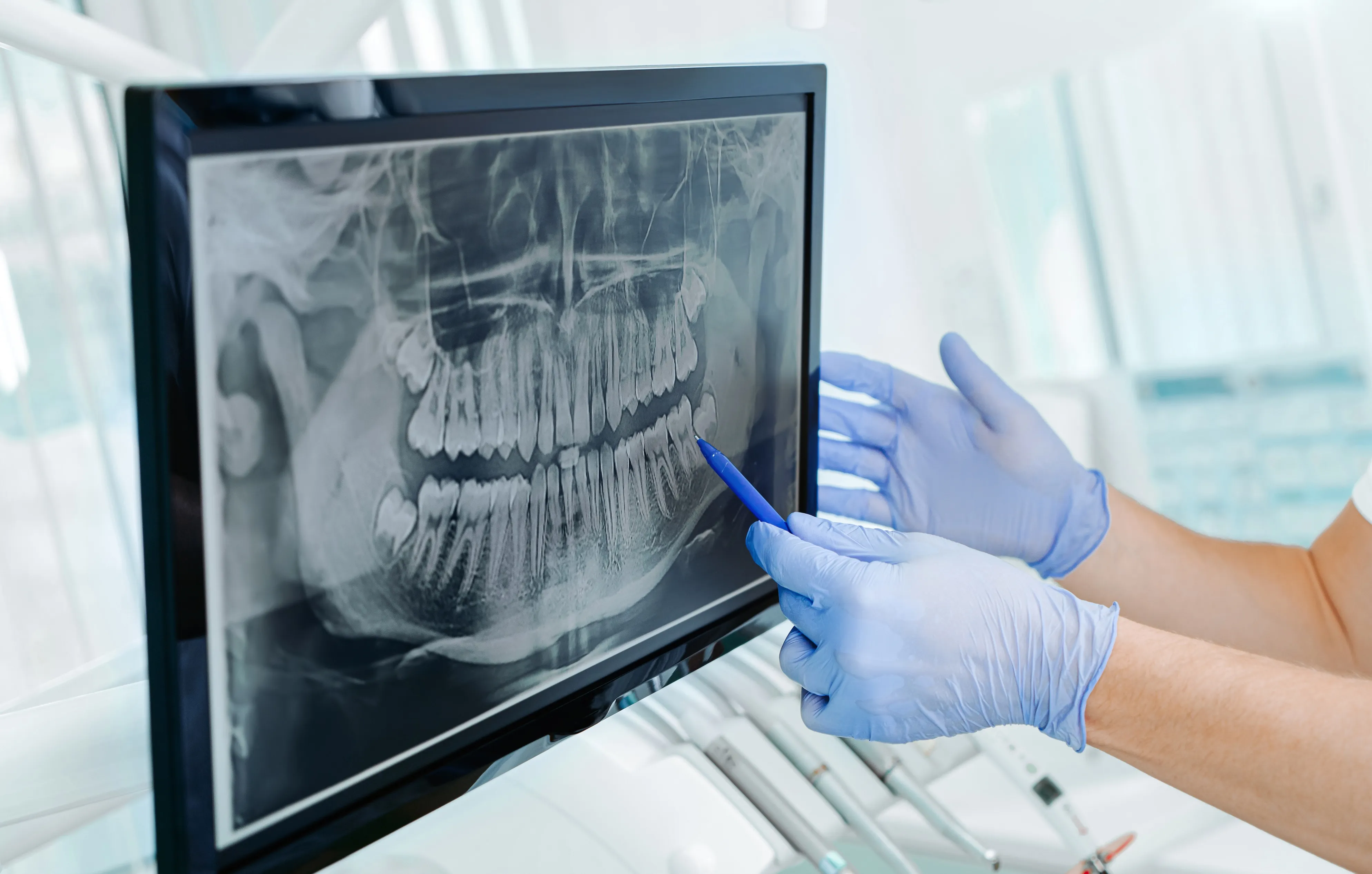 Dentist wearing blue gloves pointing with a pen at a dental X-ray on a monitor.