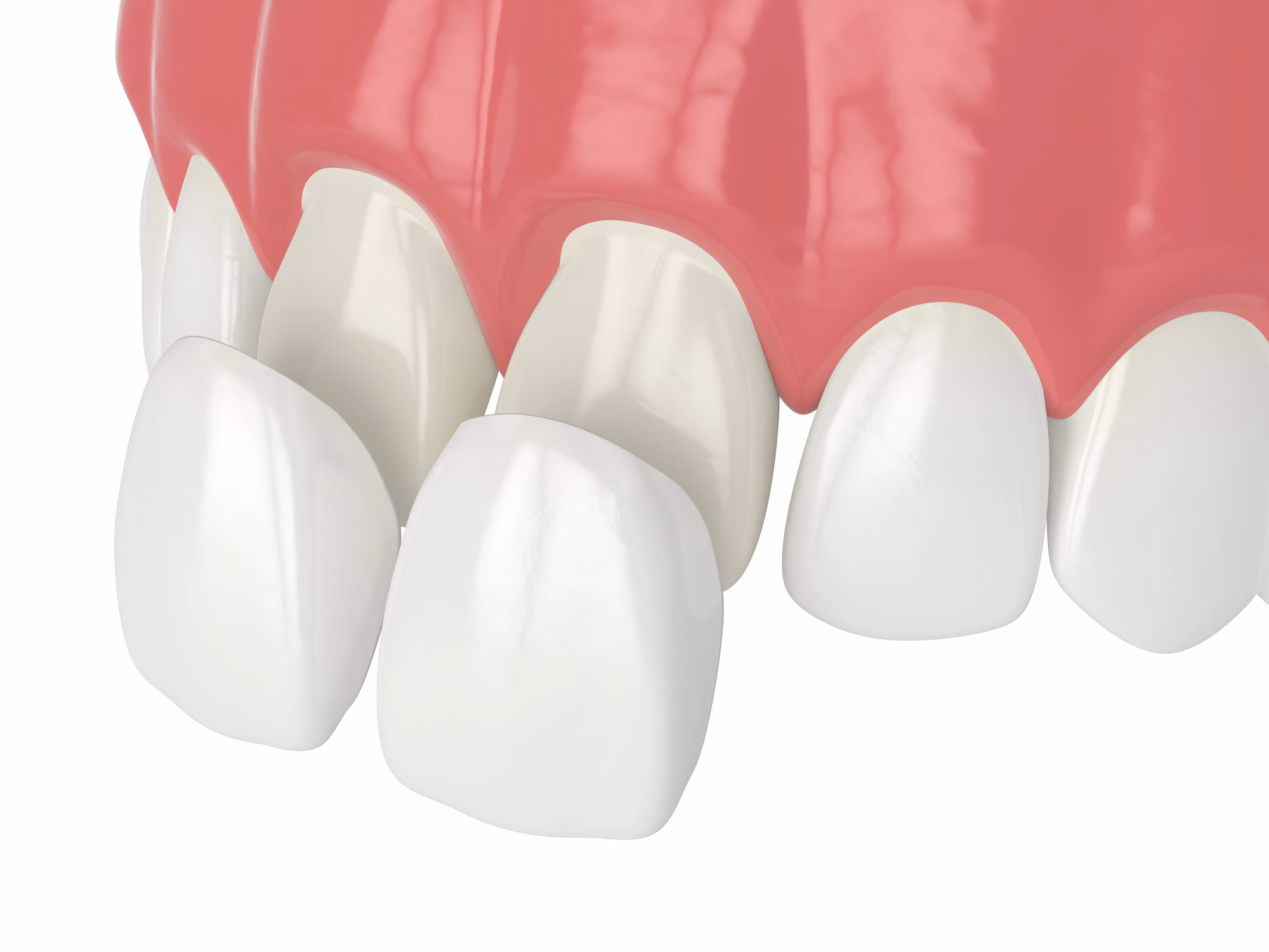 Digital illustration showing a dental crown restoration placed on a prepared tooth.