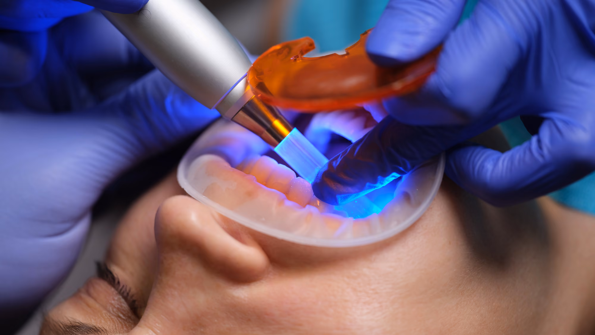 Dental whitening process using a light curing device with a whitening tray in place.