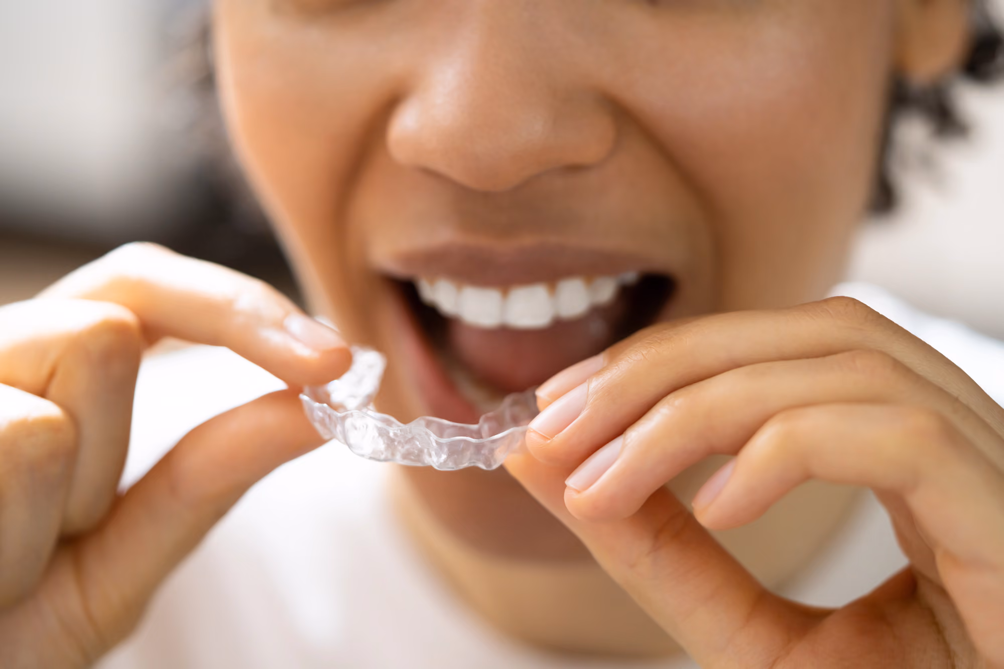 Close-up of a patient fitting a clear aligner with their hands while smiling.