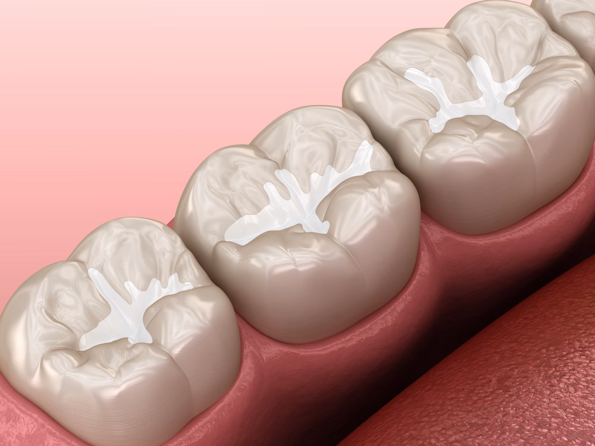 3D illustration of molars with dental fillings applied for cavity prevention.