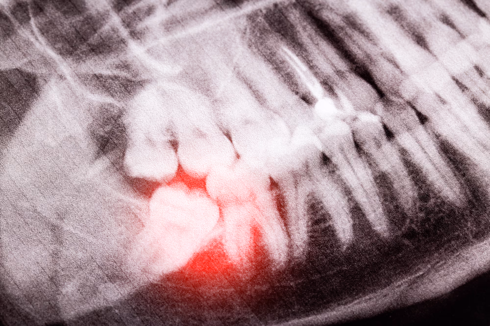 Dental X-ray showing a highlighted area indicating possible tooth pain or infection.