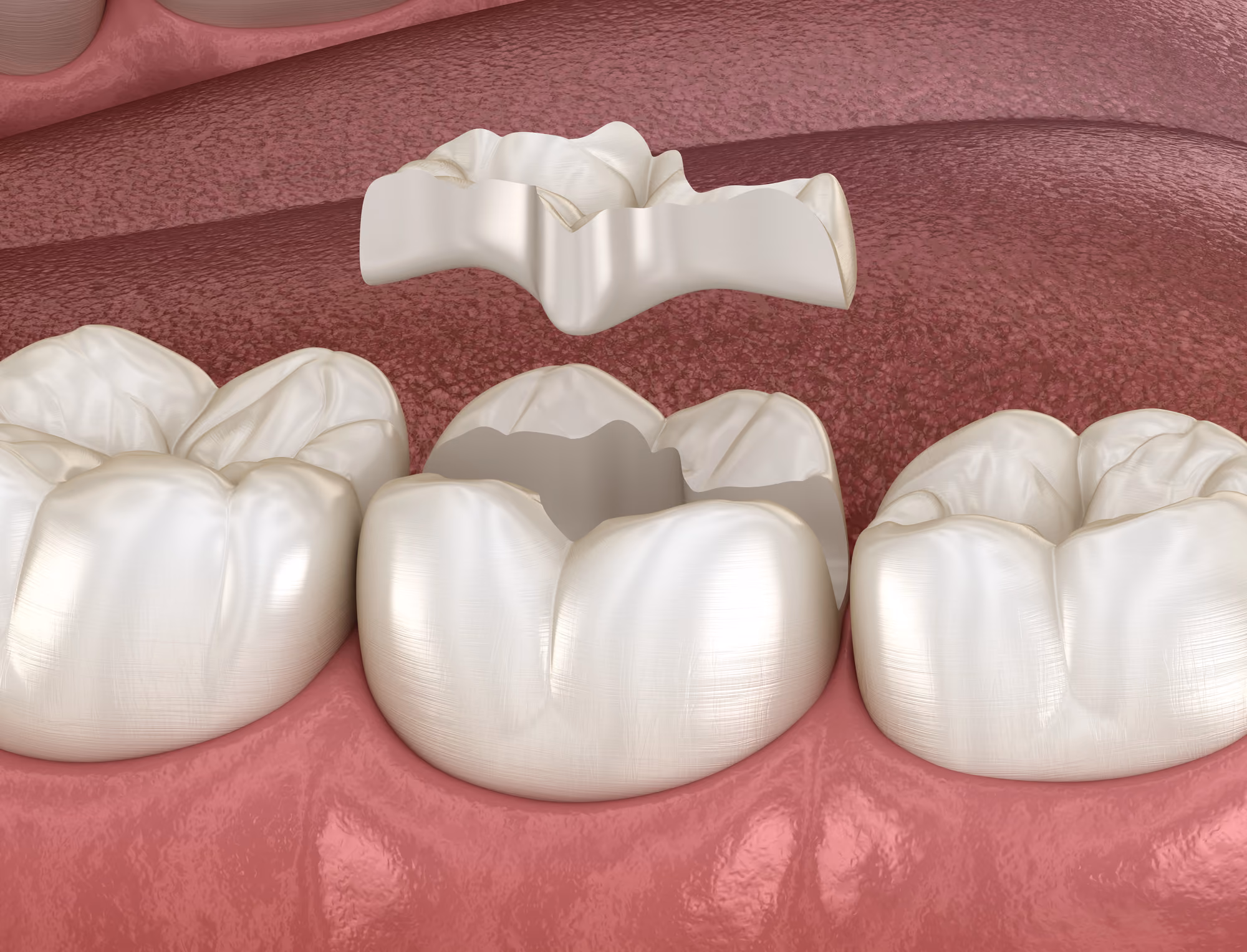 3D rendering showing a dental restoration and tooth preparation process.