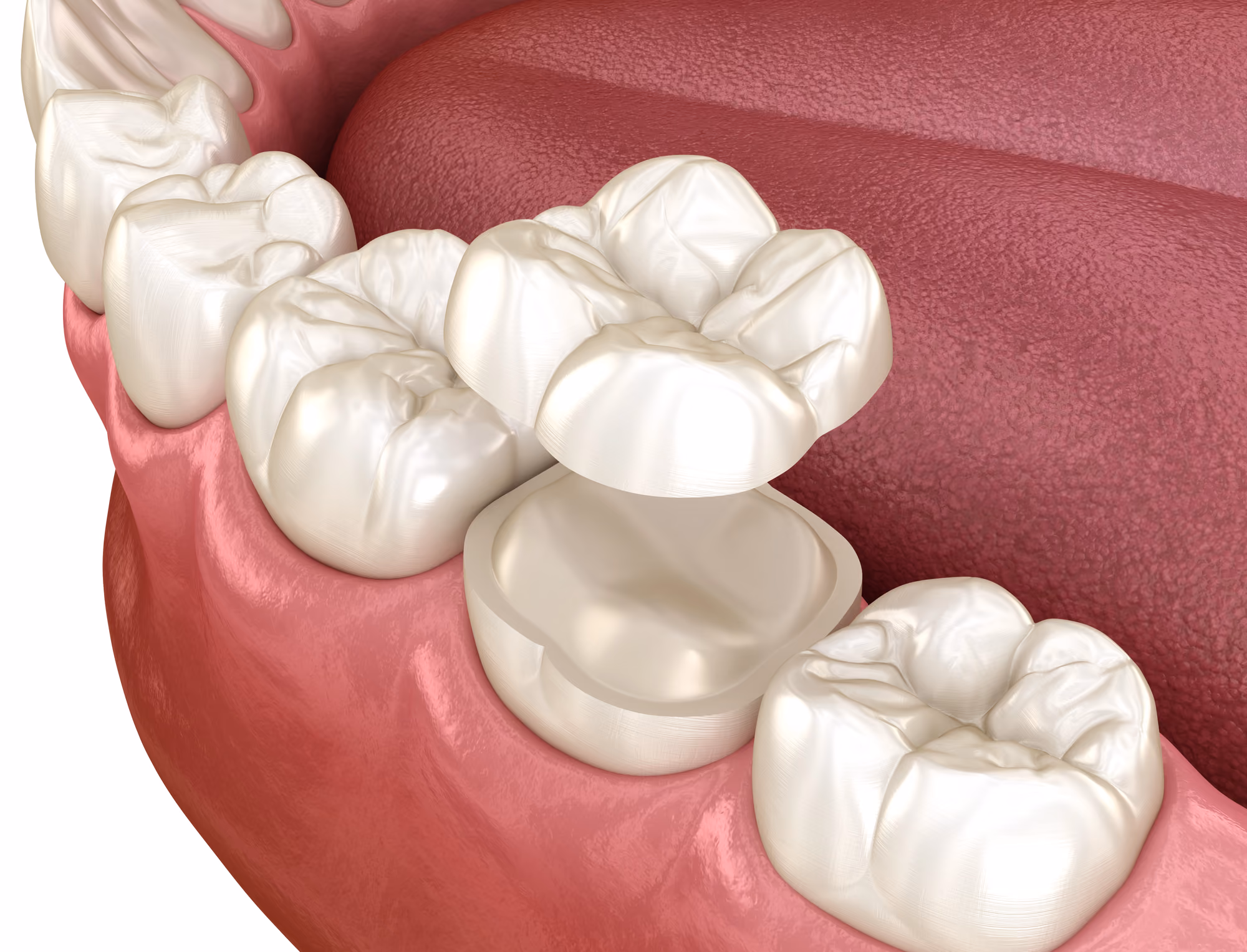 Close-up of a dental crown restoration placed on a tooth model.
