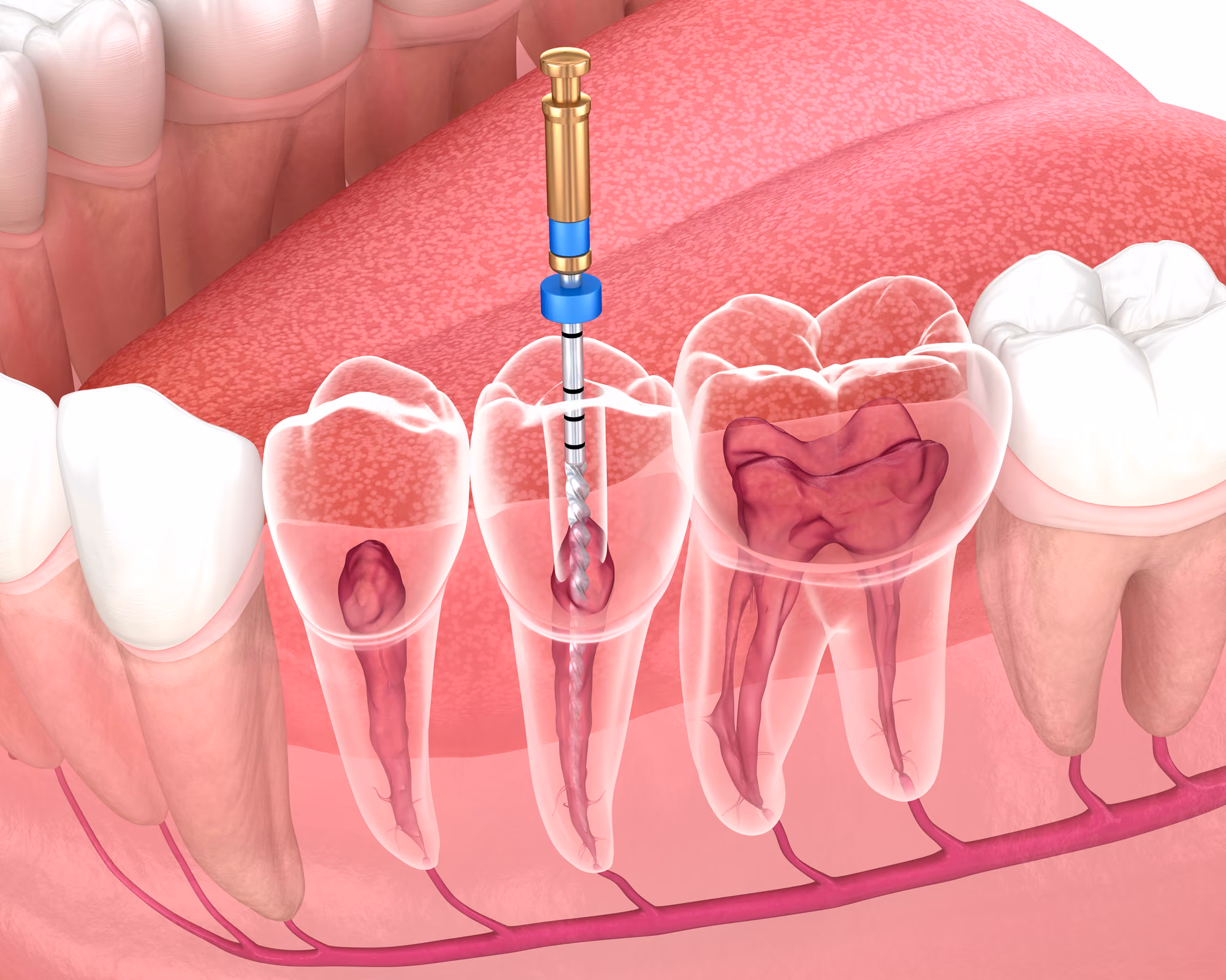 3D illustration showing a root canal procedure within the jawbone structure.