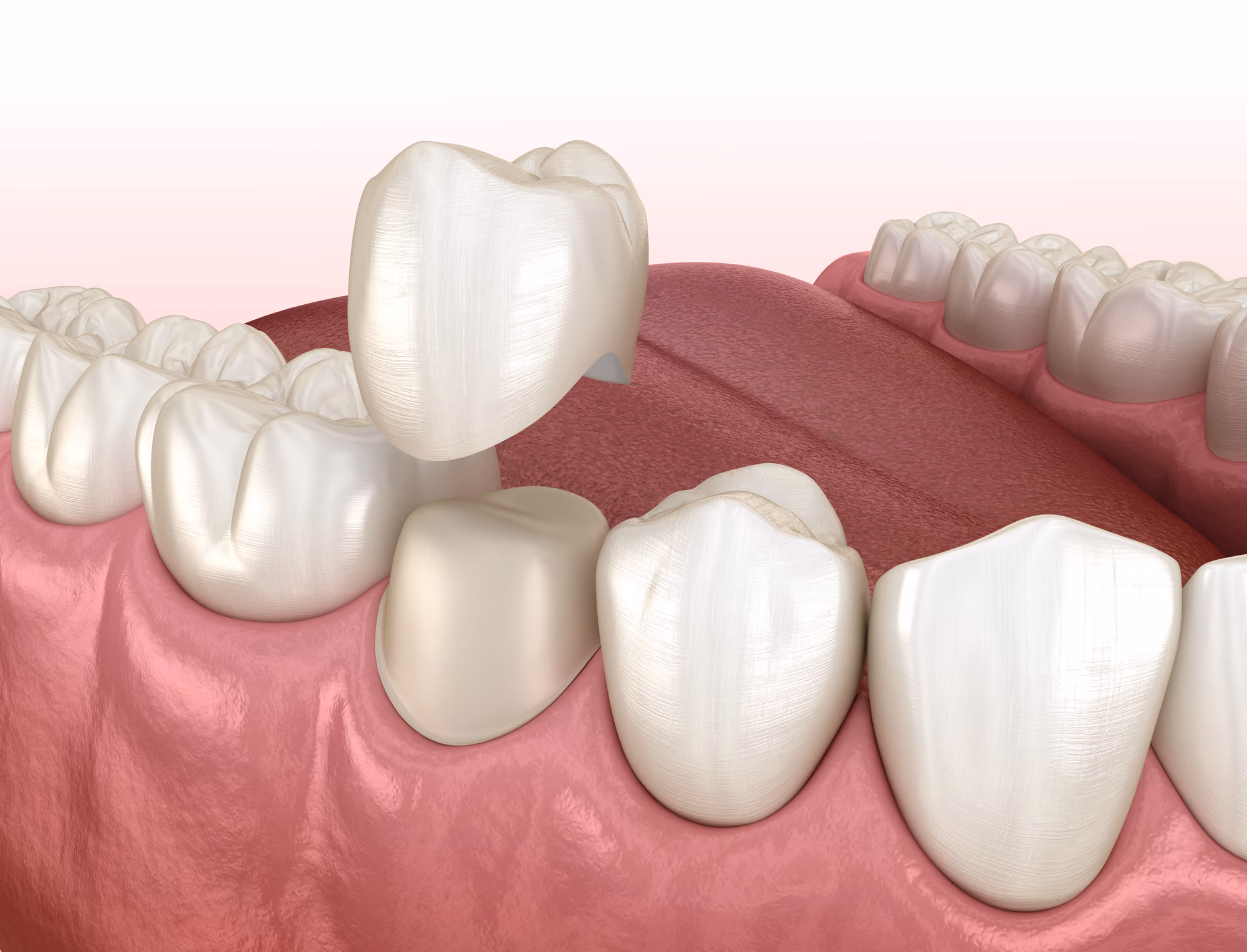 3D illustration of dental crowns and tooth structure on gums for restoration planning.