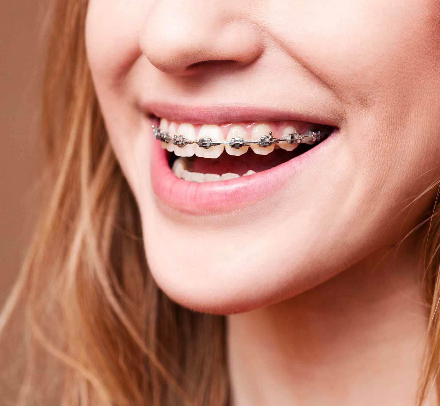 Fixed Braces
