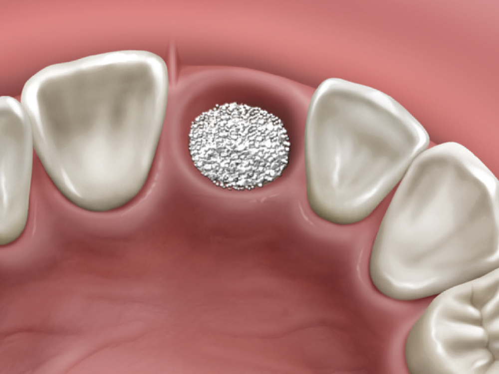 Socket Bone Graft